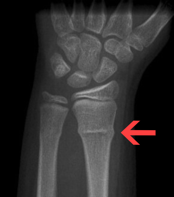 Radiologist marks fracture by hand
